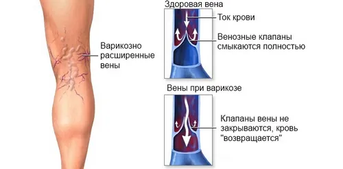 як лікувати варикоз ніг