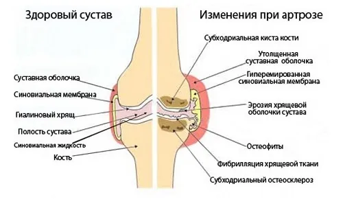лікувати деформуючий артроз колінних суглобів