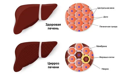 як лікувати печінку при алкоголізмі