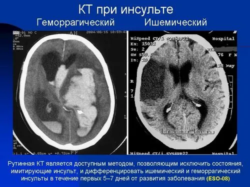 як лікувати правобічний інсульт