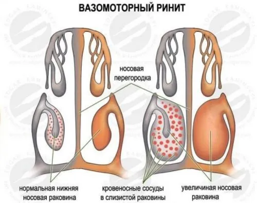 Інгаляції при риніті риніт інгаляція