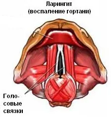 ларингіт лікування домашній умови