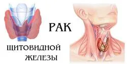 як лікувати кісту правої частки щитовидної залози