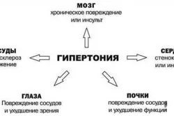 як лікувати тиск п'явками
