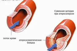 лікувати атеросклероз судин головного мозку