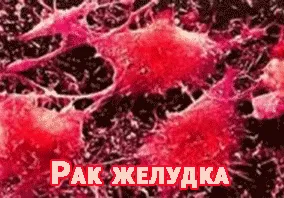 лікування народними засобами раку шлунка
