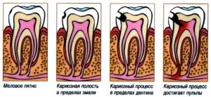 лікування глибокого карієсу в москві