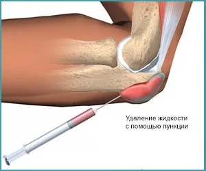 Лікування бурситу як лікувати травматичний бурсит