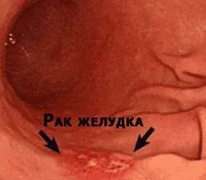 лікування народними засобами раку шлунка