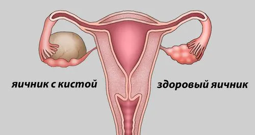 як лікувати кісту у дівчат