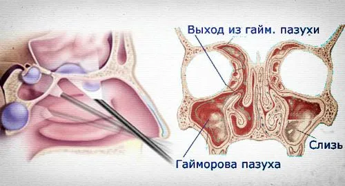 як лікувати кісту в гайморової пазухи