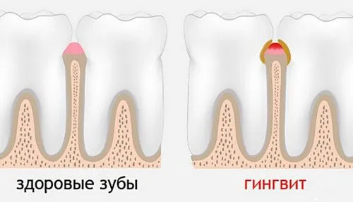 як лікувати ясна вагітним