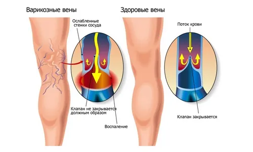 лікувати варикозне розширення вен мазі