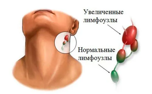 як лікувати рак лімфовузлів народними засобами