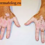 як лікувати вітіліго звіробоєм