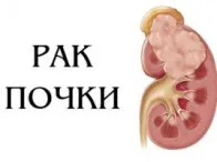 як лікувати рак нирки народними засобами