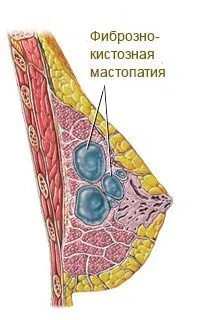 як вилікувати фіброзно кістозна мастопатію народними засобами