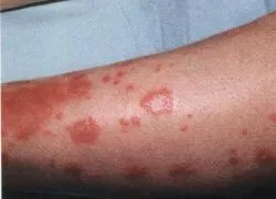 Лікування псоріазу народними способами льон звичайний