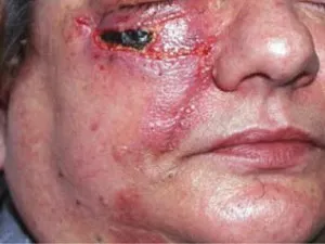 Лікування раку шкіри якщо не лікувати рак шкіри