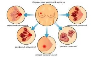 як лікувати рак молочної залози