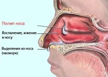 хронічний нежить поліпи