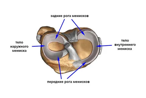 розрив заднього рогу меніска