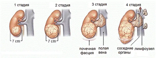 як лікувати рак нирки народними засобами