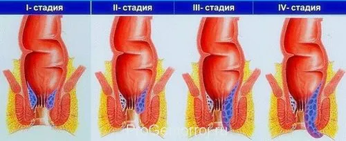 як вилікувати геморой травами
