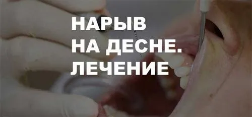 як лікувати гнійні ясна
