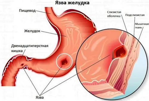 лікувати виразку шлунка народними засобами