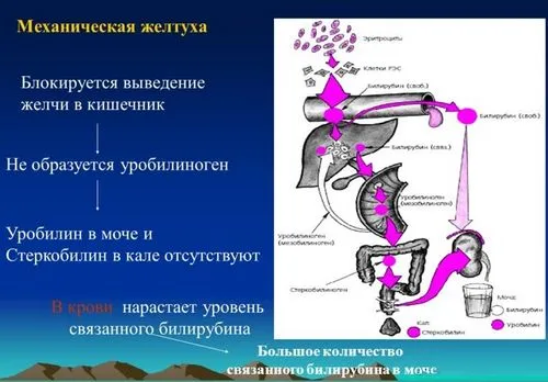 Механічна жовтяниця як лікувати механічну жовтяницю народними засобами