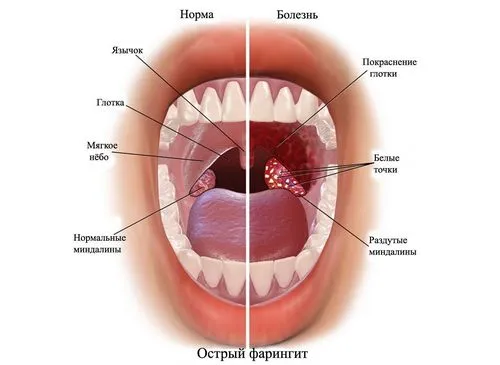 лікування фарингіту