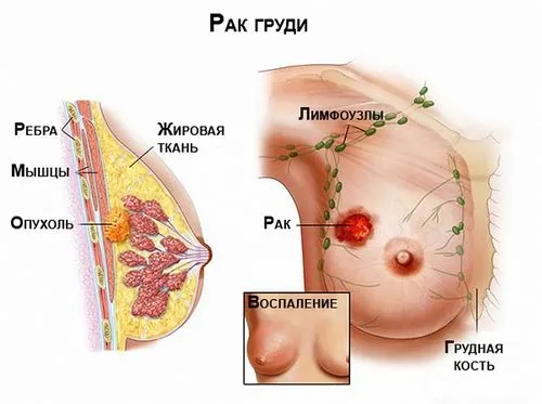 як лікувати рак молочної залози народними засобами