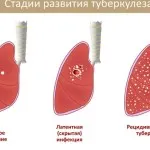 як лікувати плеврит легких
