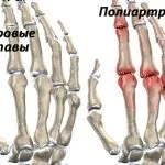як лікувати суглоби рук в домашніх умовах