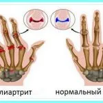 як лікувати суглоби рук в домашніх умовах