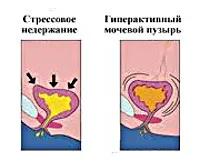 як лікувати виділення сечі