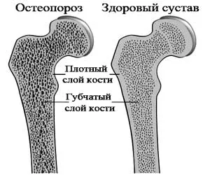 слабкі кістки хвороба