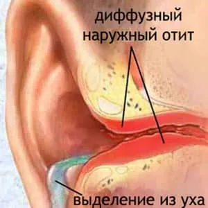 як лікувати отит вуха
