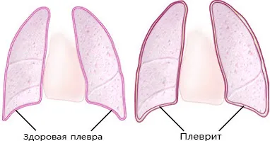 Плеврит легких як лікувати плеврит легких