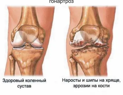 остеоартроз колінного суглоба 2 ступеня лікування народний засіб лікувати лівий