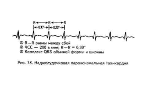 Пароксизмальнатахікардія - причини, діагностика, лікування як лікувати пароксизмальну тахікардію