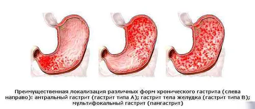 як лікувати шлунок маслом обліпихи