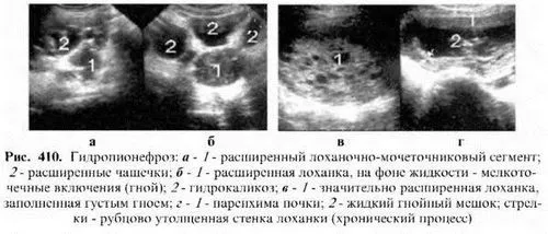 як лікувати розрив нирки