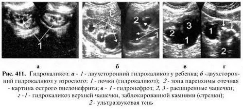 як лікувати розрив нирки