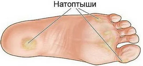 як лікувати натоптиші на ступнях в домашніх умовах