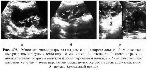 як лікувати розрив нирки