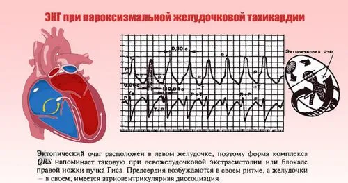 Пароксизмальнатахікардія - причини, діагностика, лікування як лікувати пароксизмальну тахікардію