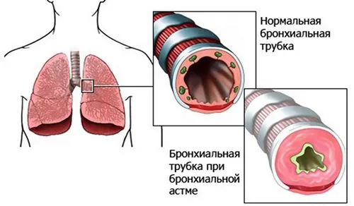 як лікувати задишку при астмі