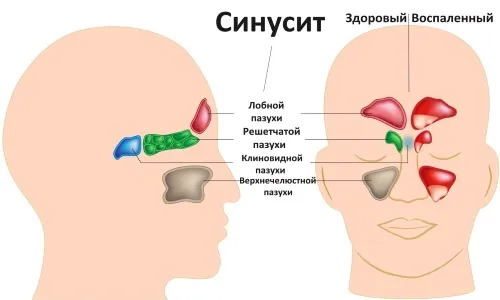 хронічний гайморит класифікація